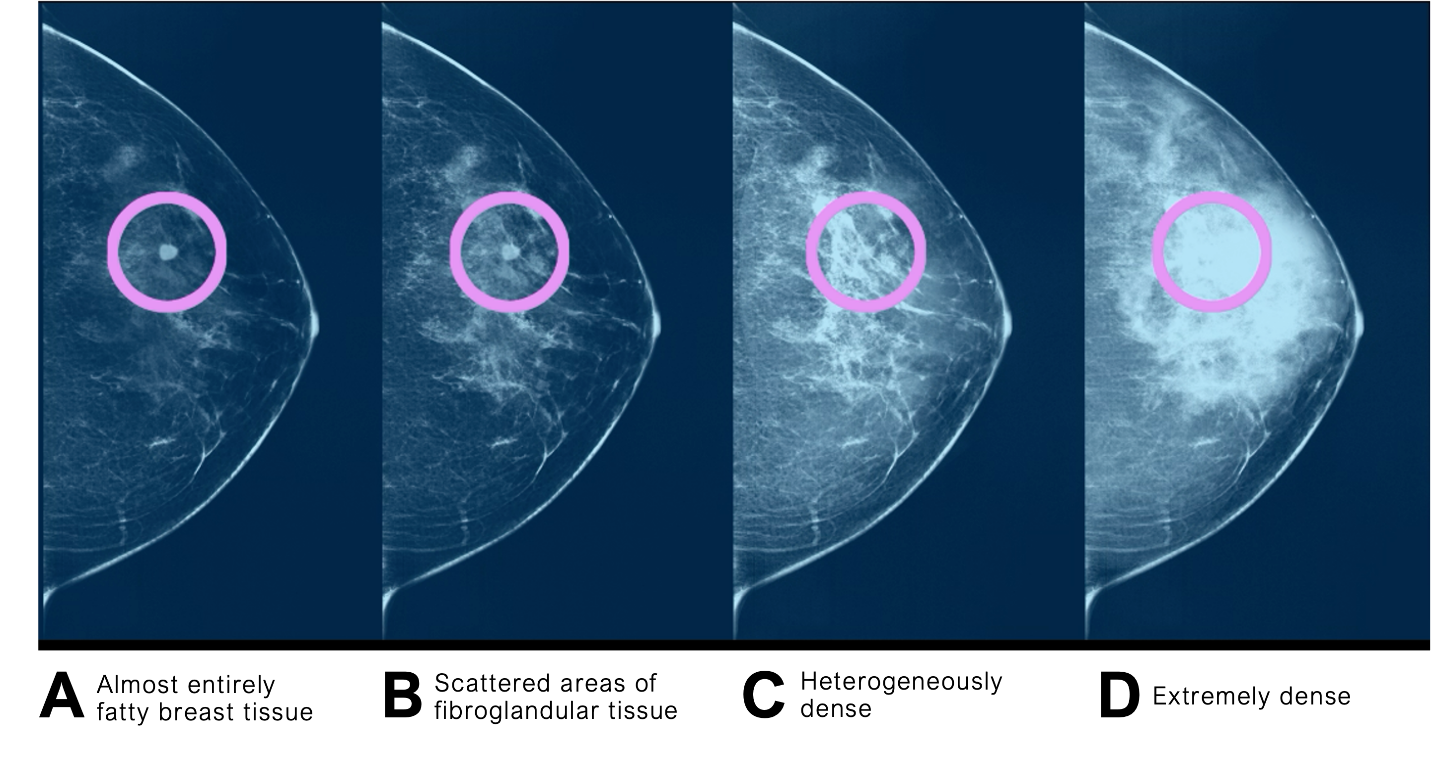 Four mammograms showing different breast density views, with two circled areas indicating potential abnormalities.