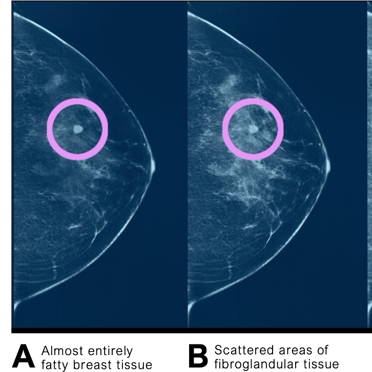 Four mammograms showing different breast density views, with circled areas indicating potential abnormalities.